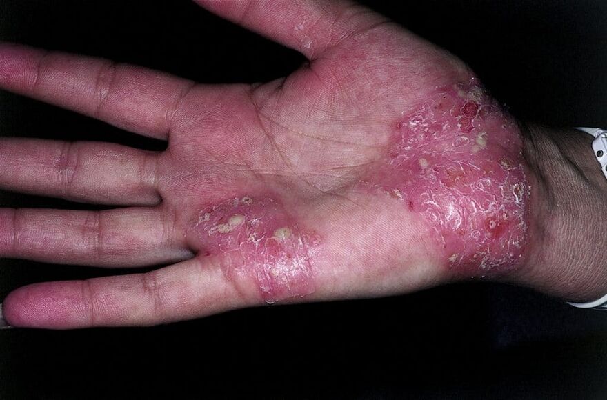 exacerbation du psoriasis sur les mains