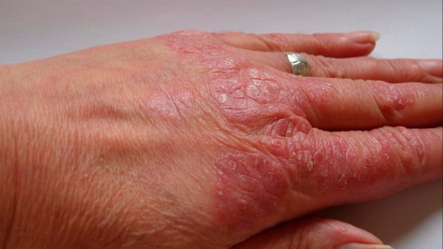 symptômes du psoriasis sur les mains