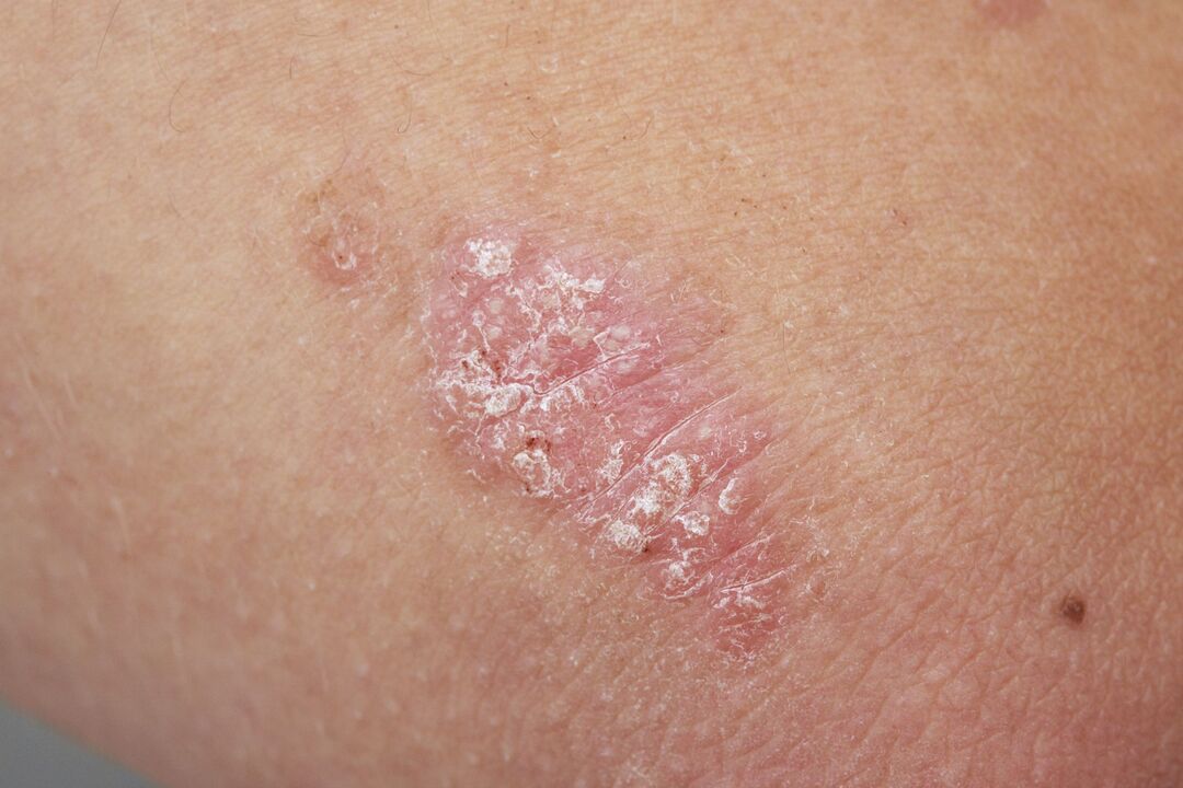 psoriasis sur la peau d'un enfant
