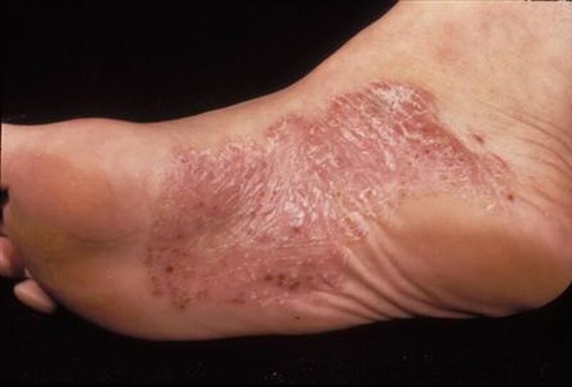 Symptômes du psoriasis des pieds