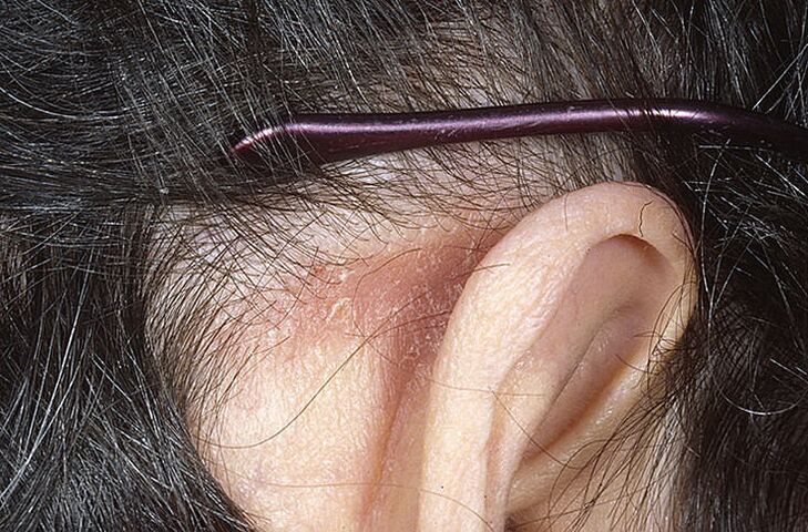 Plaque psoriasique derrière l'oreille