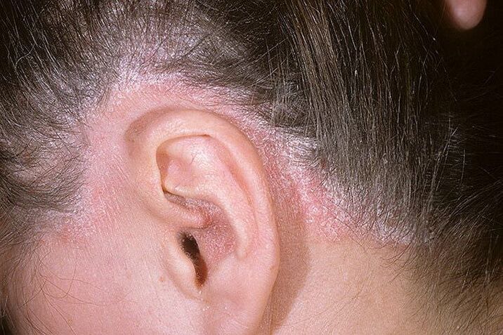 Psoriasis éruptions cutanées derrière les oreilles
