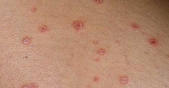 Plaques psoriaux