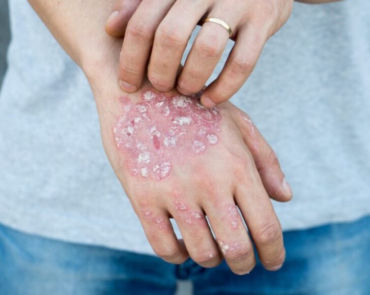 Psoriasis entre les mains