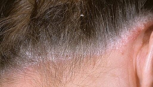 Psoriasis sur la tête