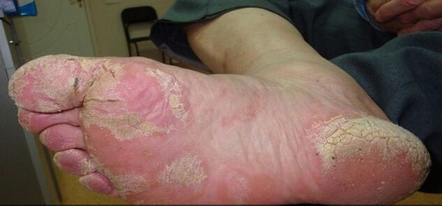 Psoriasis sur les jambes