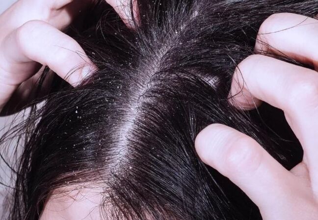 Psoriasis sur la tête