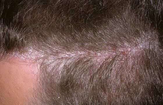 Psoriasis sur la tête
