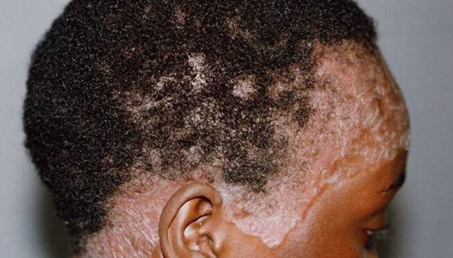Psoriasis sur la tête