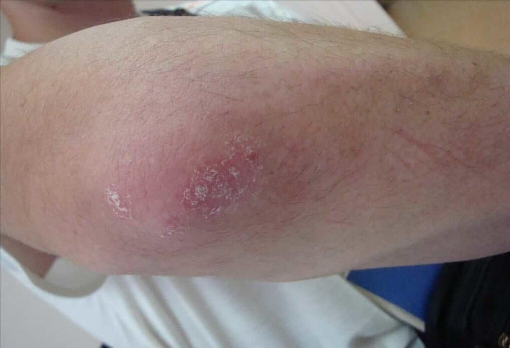 Ce que fait un psoriasis