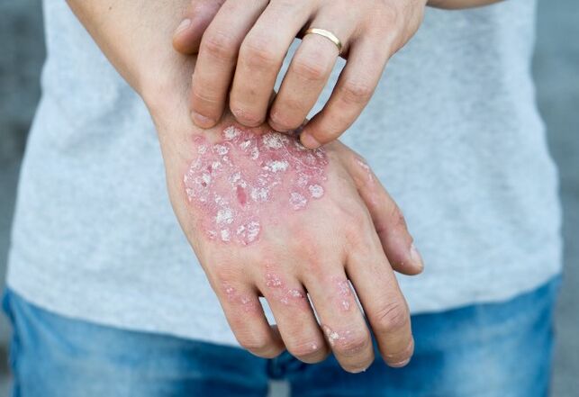 Psoriasis mesnicherata