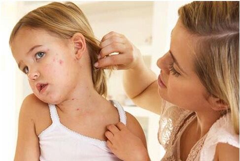 Psoriasis chez les enfants