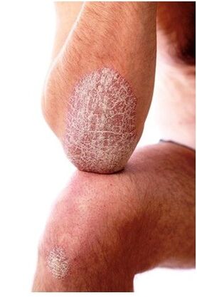 Psoriasis sur le coude