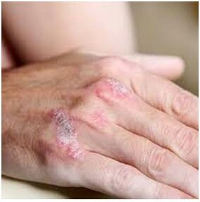 Psoriasis sur le pinceau