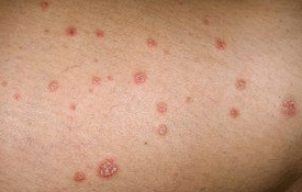 Plaques psoriaux