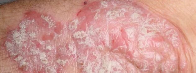 Psoriasis mesnicherata