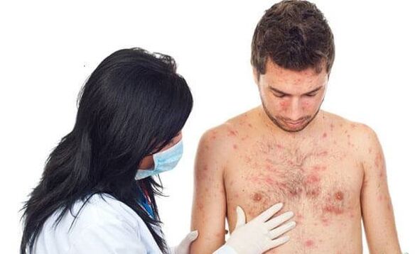 Photo du psoriasis