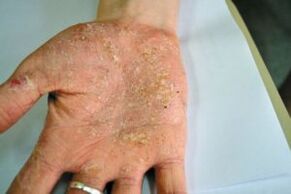 Psoriasis dans la paume de votre main