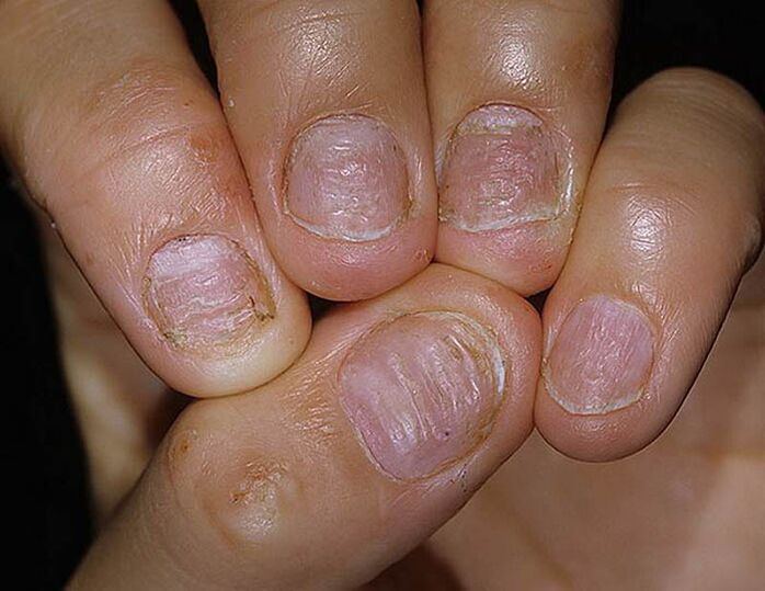 Psoriasis de clou