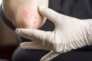 Psoriasis sur le coude
