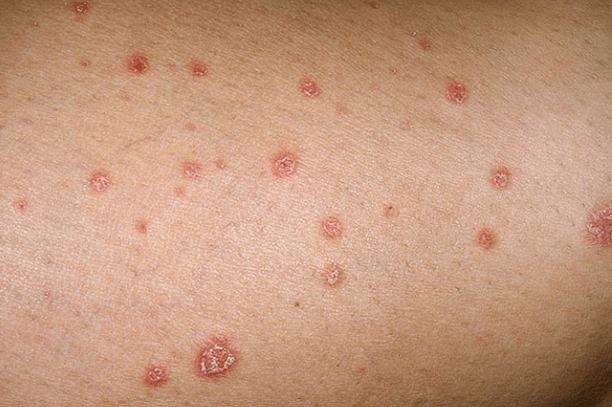 Plaques psoriasiques