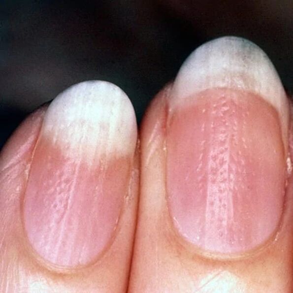 Psoriasis des ongles