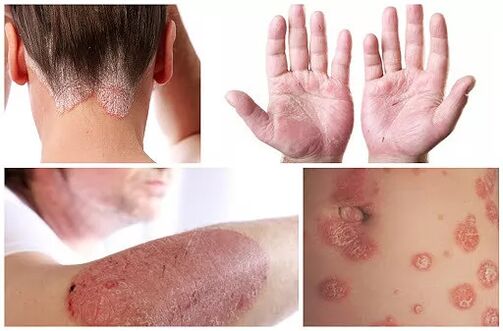 Manifestations du psoriasis dans différentes parties du corps