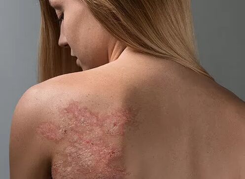Psoriasis sur le dos d'une fille