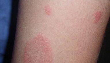 Comment se manifeste le stade initial du psoriasis
