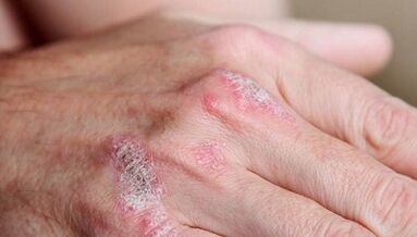symptômes de la phase initiale du psoriasis