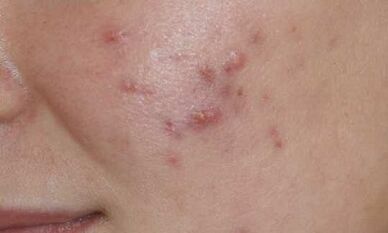 symptômes de la phase initiale du psoriasis