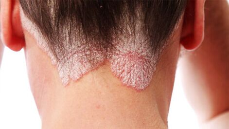 Plaques psoriasiques sur le cuir chevelu
