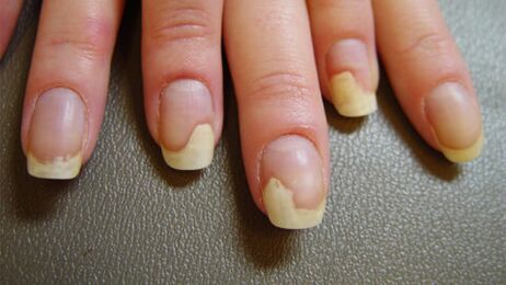 Taches blanches sur les ongles dues au psoriasis