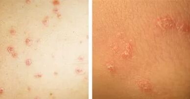 principales manifestations du psoriasis