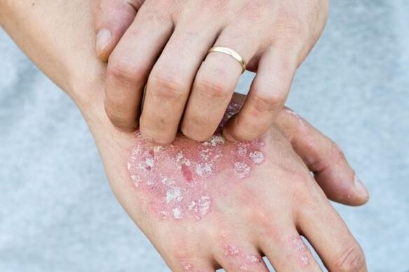 Symptômes caractéristiques du psoriasis sur les mains