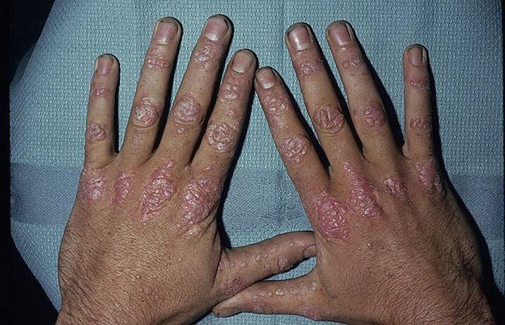 raisons du développement du psoriasis sur les mains