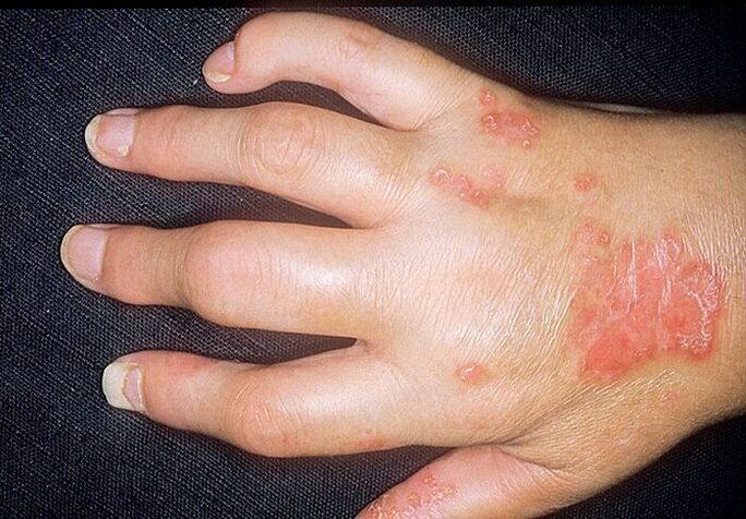 arthrite psoriasique sur les mains