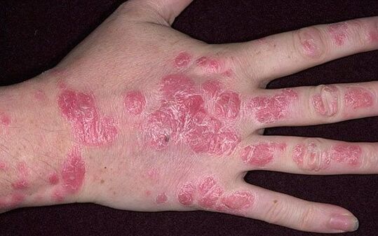 psoriasis en plaques sur les mains