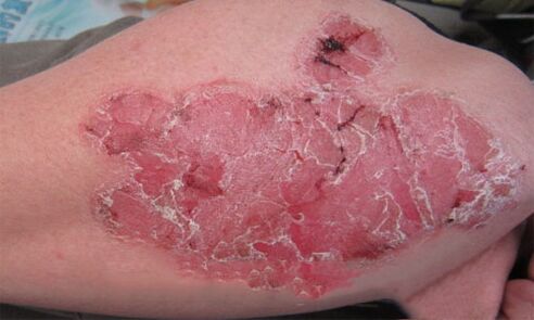 à quoi ressemble le psoriasis pustuleux sur la peau