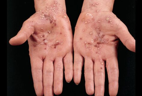 à quoi ressemble le psoriasis sur la paume de vos mains