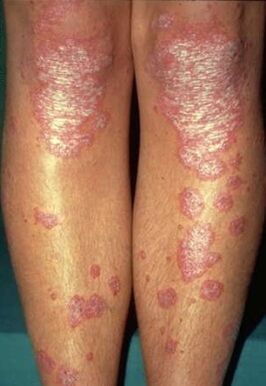Manifestations de psoriasis sur les jambes