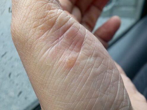 photo du psoriasis sur la main