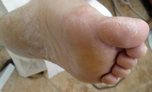 Psoriasis du pied