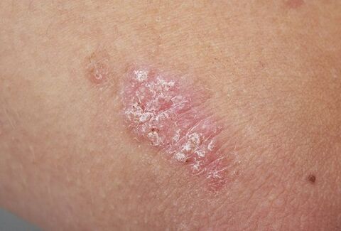 plaque psoriasique sur la peau