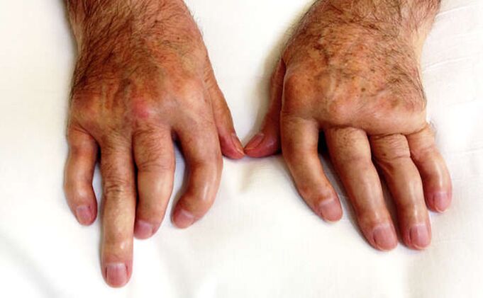 Arthrite mutilante dans le psoriasis