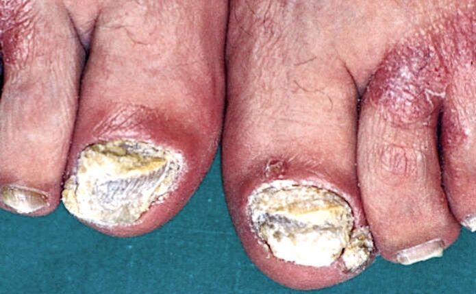 Hyperkératose sous-unguéale sévère et plaques psoriasiques sur les orteils