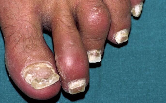 Psoriasis avec atteinte des ongles et inflammation des articulations (arthrite) des orteils