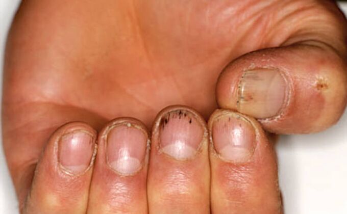 Saignement sous les ongles avec psoriasis