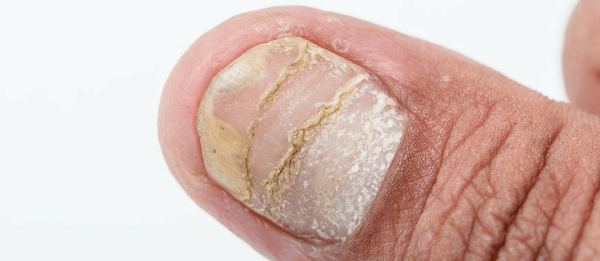 forme aiguë de complications du psoriasis sur l'ongle