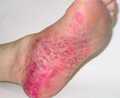 psoriasis des pieds